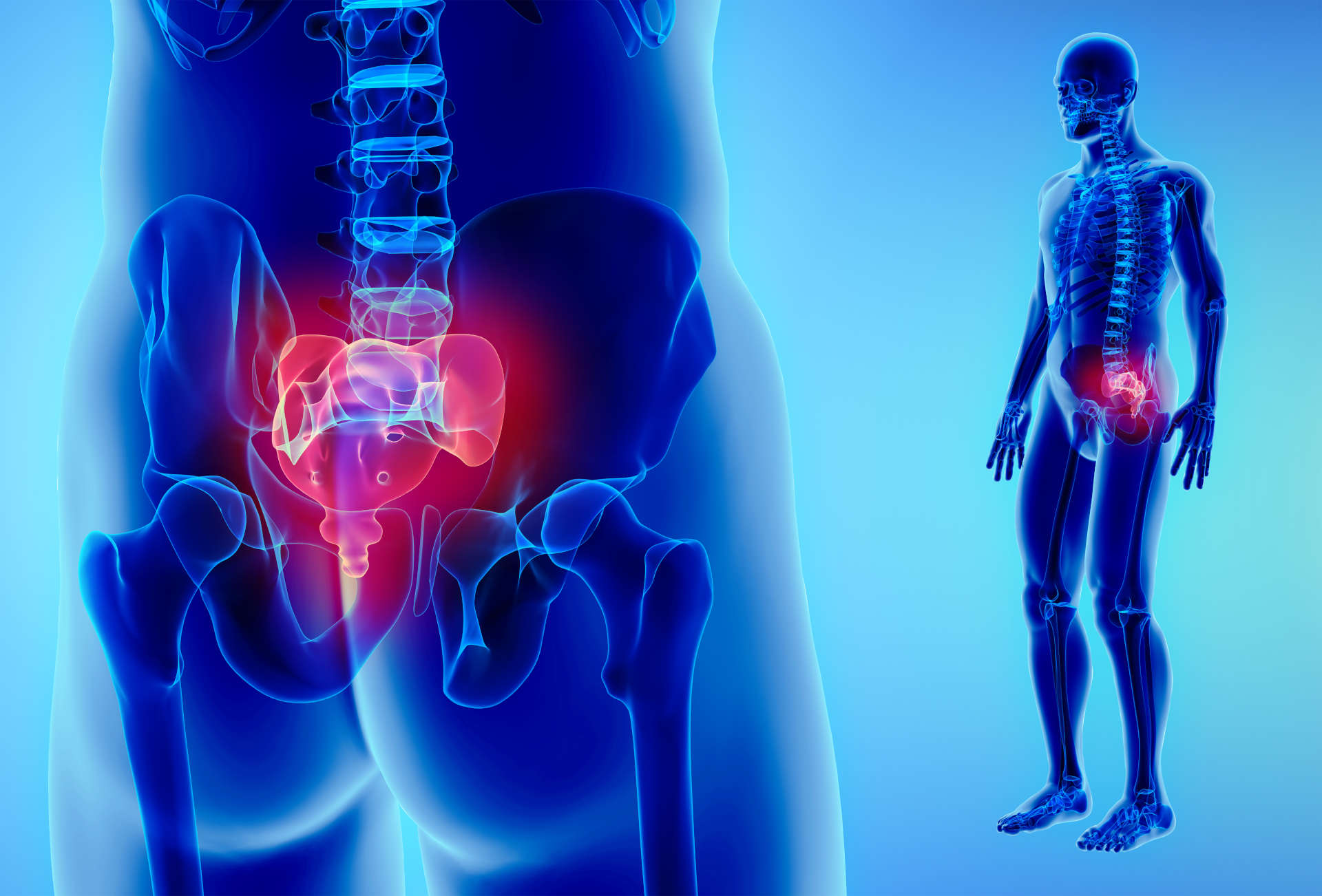 Small Muscle Causes BIG Pain: Relieve Piriformis Syndrome with